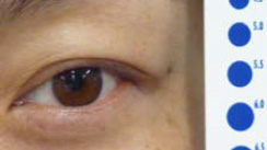 眼睛检查